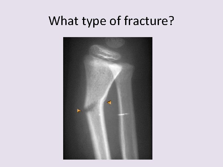 What type of fracture? 