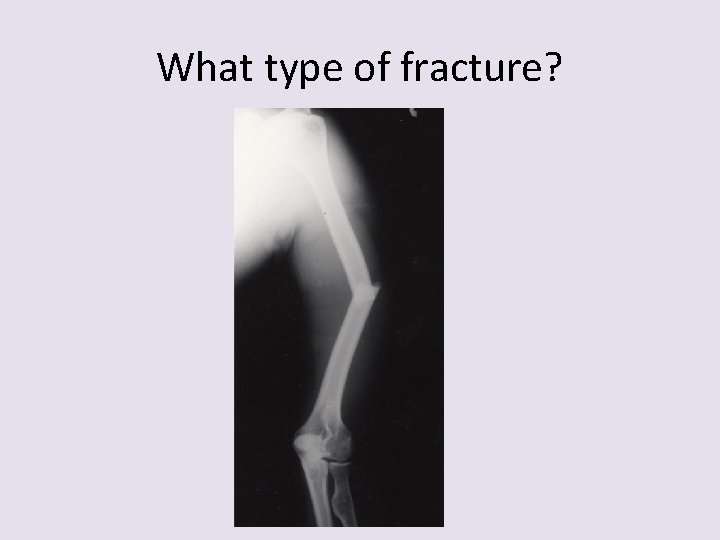 What type of fracture? 