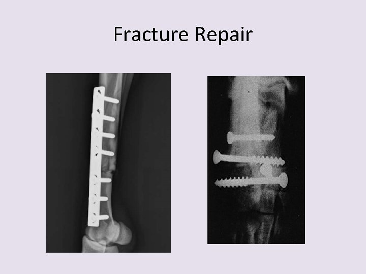 Fracture Repair 