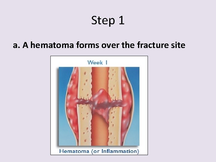 Step 1 a. A hematoma forms over the fracture site 