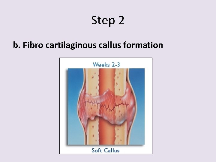 Step 2 b. Fibro cartilaginous callus formation 