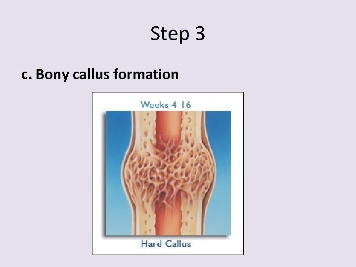 Step 3 c. Bony callus formation 