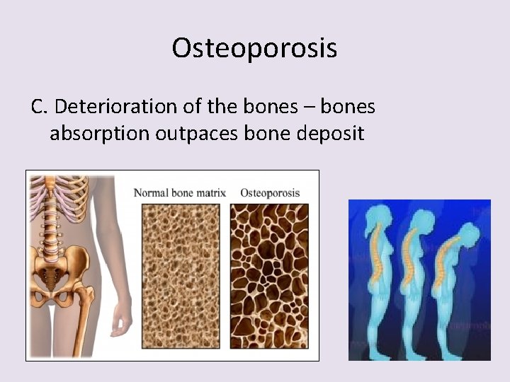 Osteoporosis C. Deterioration of the bones – bones absorption outpaces bone deposit 