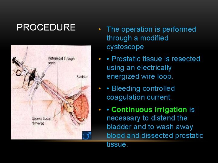 PROCEDURE • The operation is performed through a modified cystoscope • • Prostatic tissue