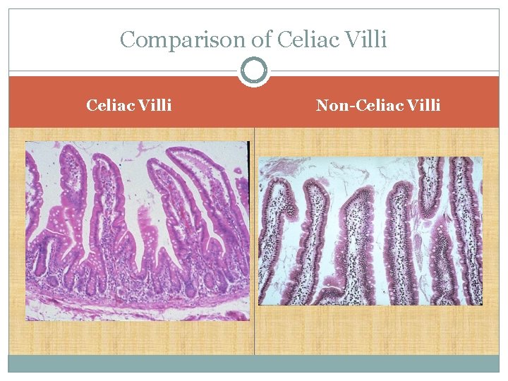 Comparison of Celiac Villi Non-Celiac Villi 