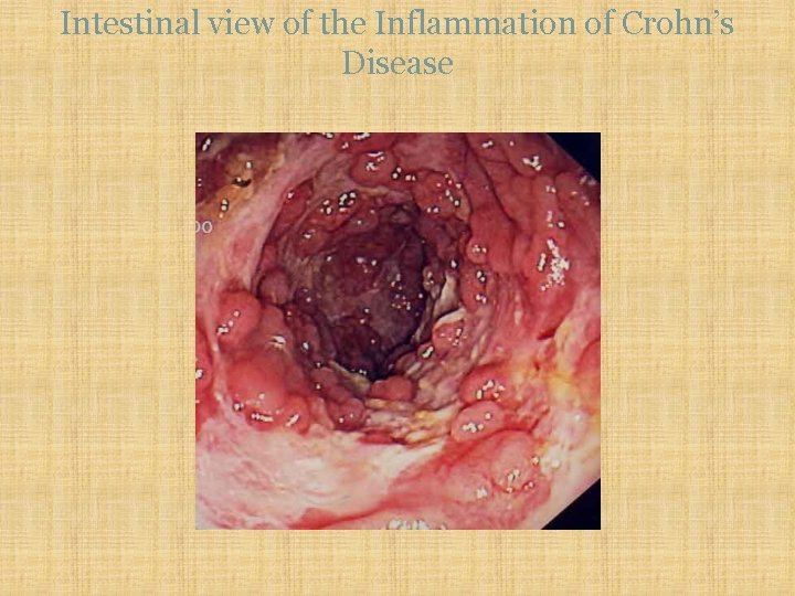 Intestinal view of the Inflammation of Crohn’s Disease 