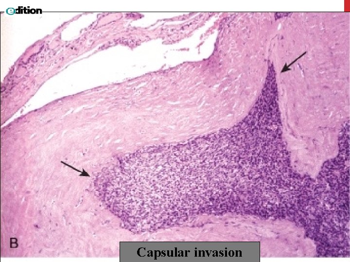 Capsular invasion 