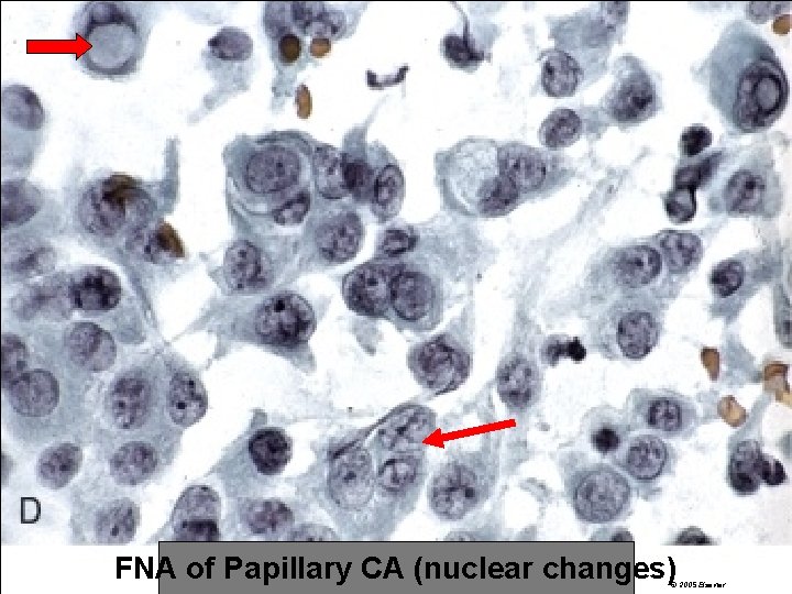 FNA of Papillary CA (nuclear changes) © 2005 Elsevier 