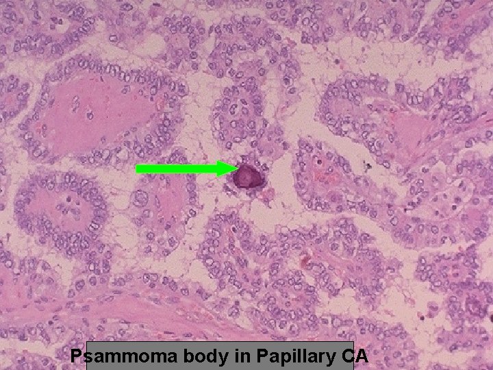 Psammoma body in Papillary CA 