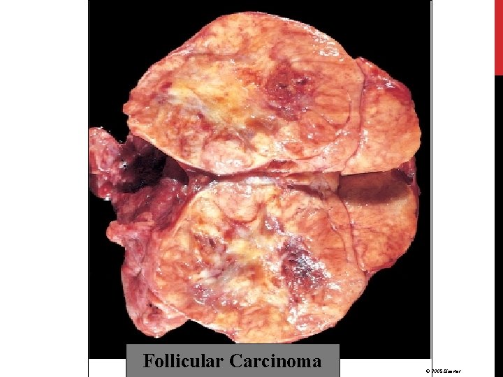 Follicular Carcinoma © 2005 Elsevier 