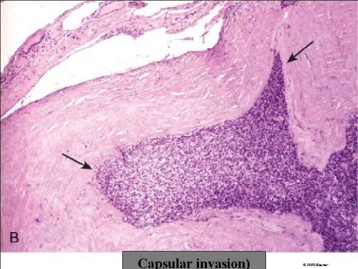 Capsular invasion) © 2005 Elsevier 