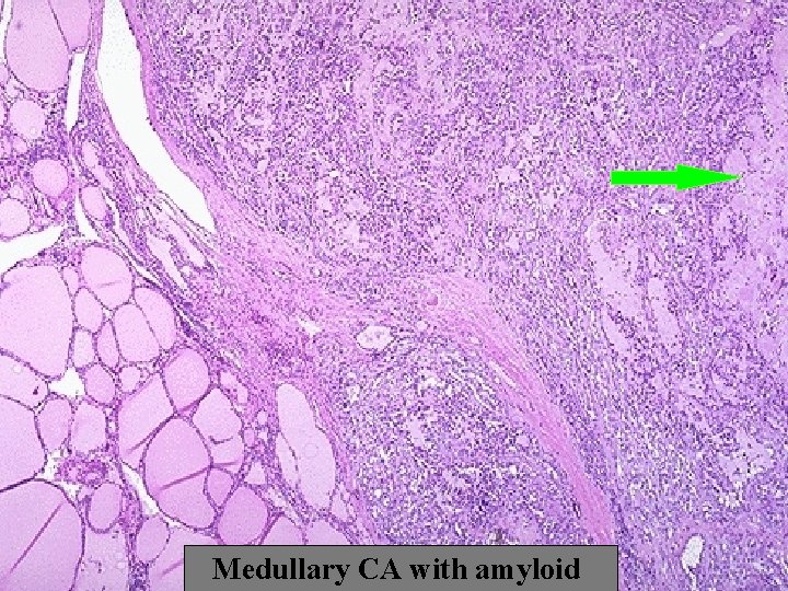 Medullary CA with amyloid 
