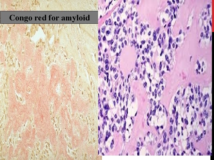 Congo red for amyloid 