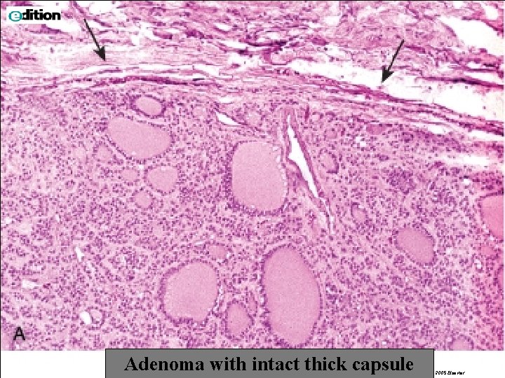 Adenoma with intact thick capsule © 2005 Elsevier 