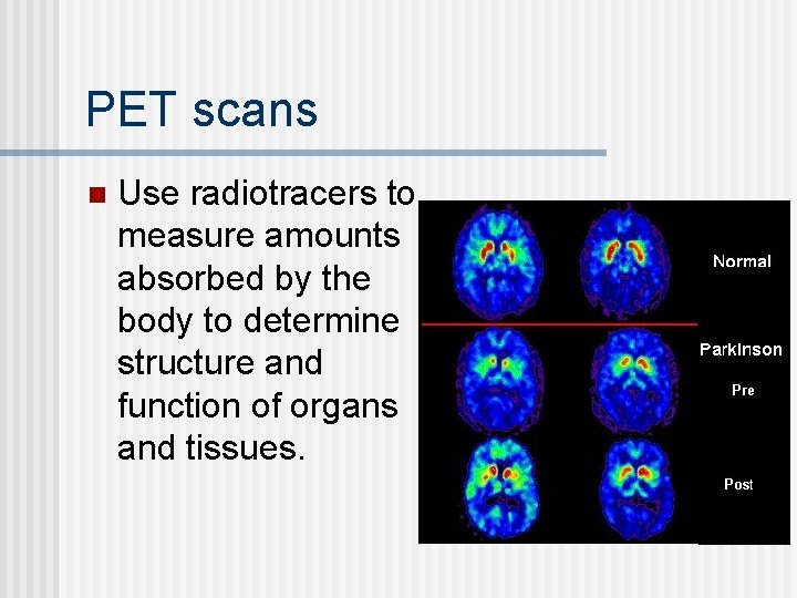 PET scans n Use radiotracers to measure amounts absorbed by the body to determine