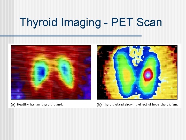 Thyroid Imaging - PET Scan 