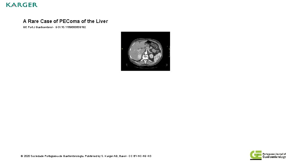 A Rare Case of PEComa of the Liver GE Port J Gastroenterol - DOI: