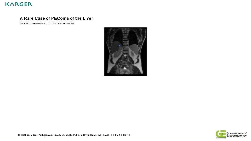 A Rare Case of PEComa of the Liver GE Port J Gastroenterol - DOI: