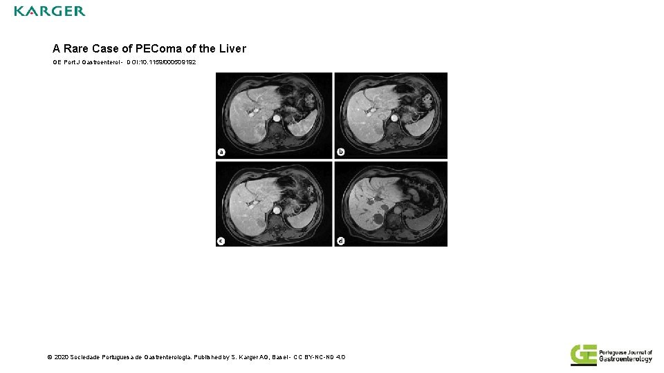 A Rare Case of PEComa of the Liver GE Port J Gastroenterol - DOI: