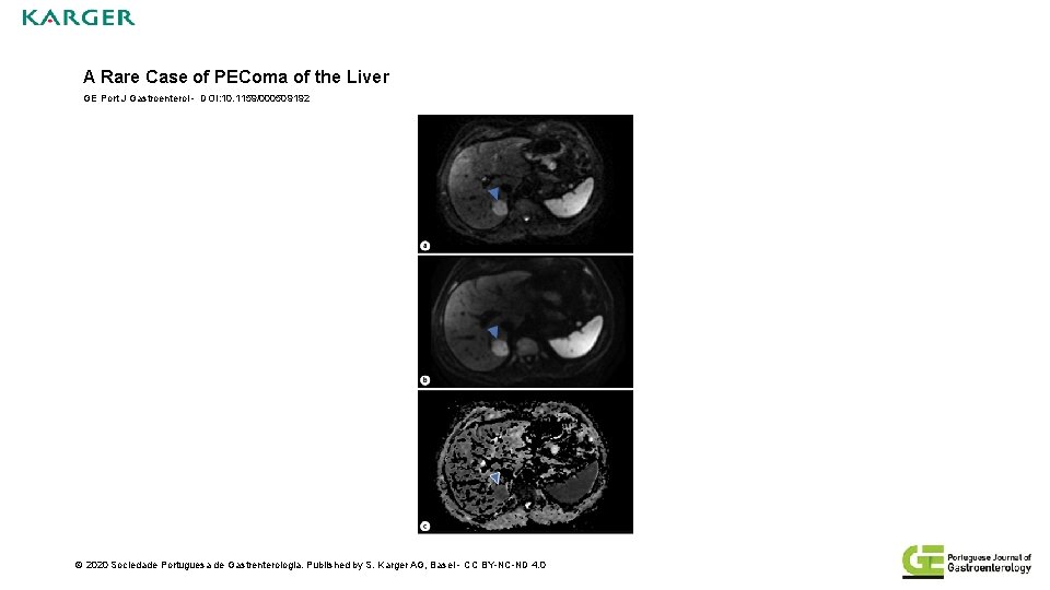 A Rare Case of PEComa of the Liver GE Port J Gastroenterol - DOI: