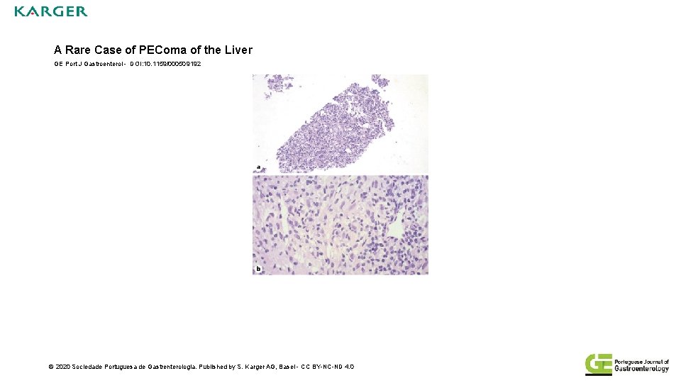 A Rare Case of PEComa of the Liver GE Port J Gastroenterol - DOI:
