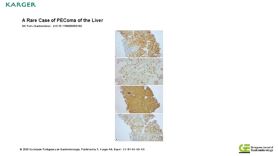A Rare Case of PEComa of the Liver GE Port J Gastroenterol - DOI: