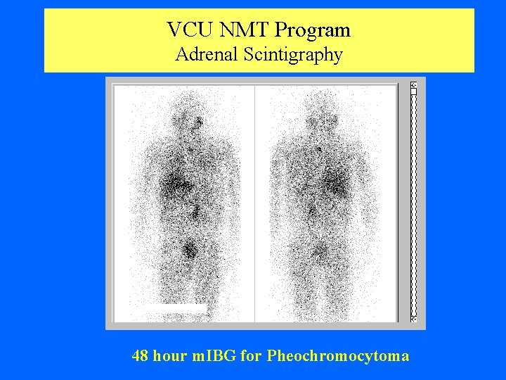 VCU NMT Program Adrenal Scintigraphy 48 hour m. IBG for Pheochromocytoma 