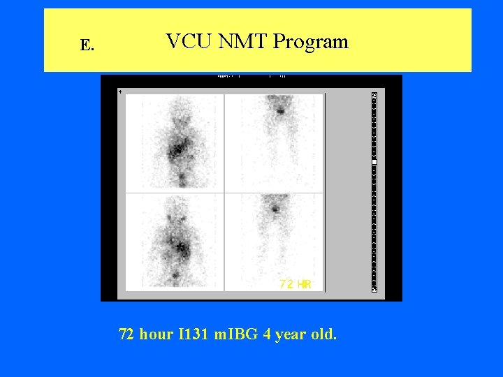 E. VCU NMT Program 72 hour I 131 m. IBG 4 year old. 