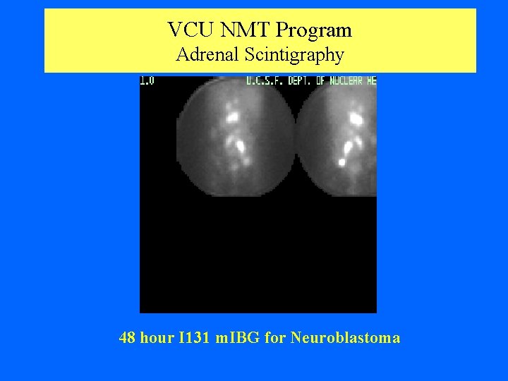VCU NMT Program Adrenal Scintigraphy 48 hour I 131 m. IBG for Neuroblastoma 