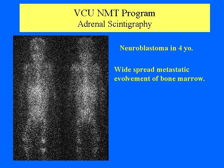 VCU NMT Program Adrenal Scintigraphy Neuroblastoma in 4 yo. Wide spread metastatic evolvement of