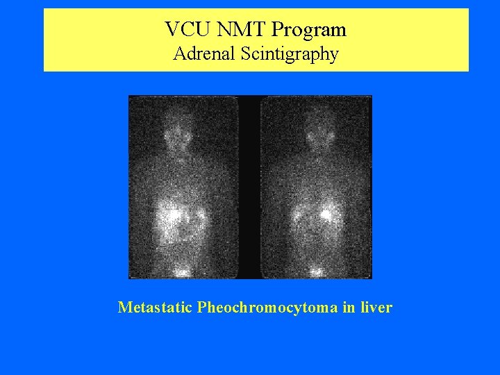 VCU NMT Program Adrenal Scintigraphy Metastatic Pheochromocytoma in liver 