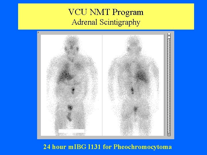 VCU NMT Program Adrenal Scintigraphy 24 hour m. IBG I 131 for Pheochromocytoma 