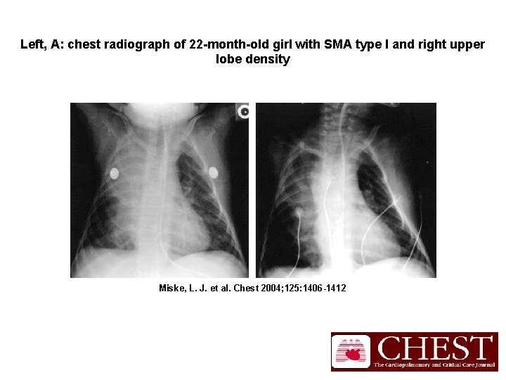 Left, A: chest radiograph of 22 -month-old girl with SMA type I and right