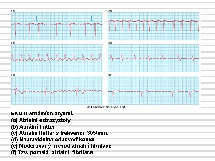 EKG u atriálních arytmií. (a) Atriální extrasystoly (b) Atriální flutter (c) Atriální flutter s