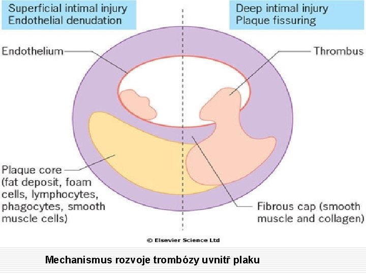 Mechanismus rozvoje trombózy uvnitř plaku 