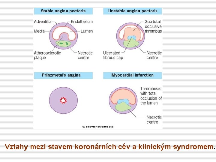 Vztahy mezi stavem koronárních cév a klinickým syndromem 