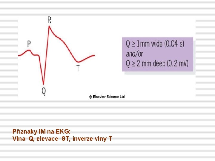 Příznaky IM na EKG: Vlna Q, elevace ST, inverze vlny T 