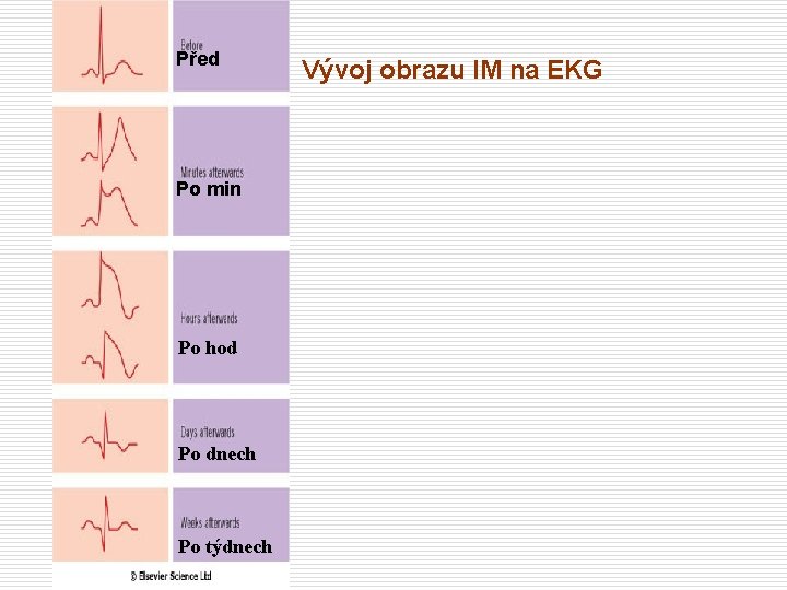 Před Po min Po hod Po dnech Po týdnech Vývoj obrazu IM na EKG