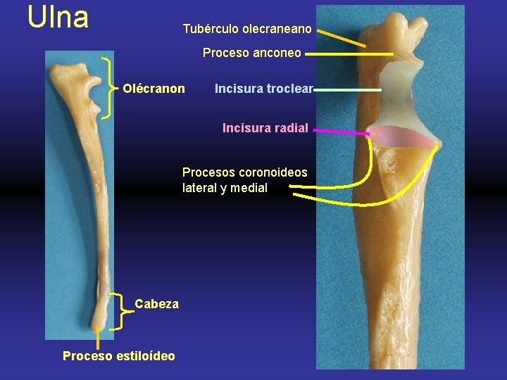 Ulna Tubérculo olecraneano Proceso anconeo Olécranon Incisura troclear Incisura radial Procesos coronoideos lateral y