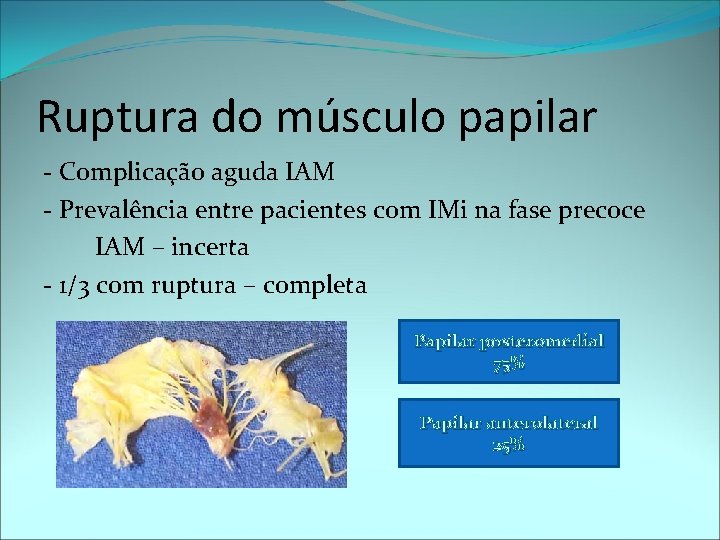Ruptura do músculo papilar - Complicação aguda IAM - Prevalência entre pacientes com IMi