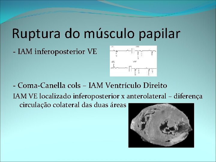 Ruptura do músculo papilar - IAM inferoposterior VE - Coma-Canella cols – IAM Ventrículo