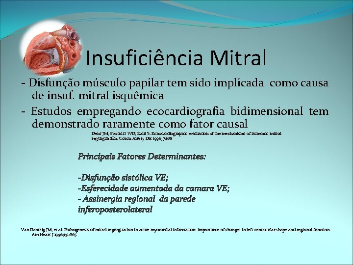 Insuficiência Mitral - Disfunção músculo papilar tem sido implicada como causa de insuf. mitral