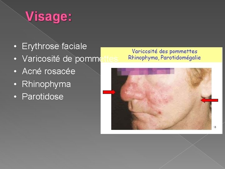 Visage: • • • Erythrose faciale Varicosité de pommettes Acné rosacée Rhinophyma Parotidose 