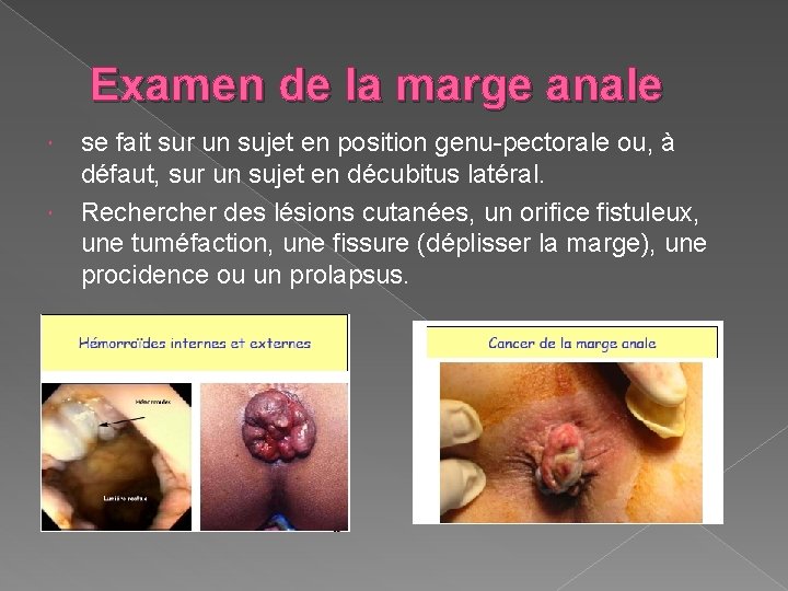 Examen de la marge anale se fait sur un sujet en position genu-pectorale ou,