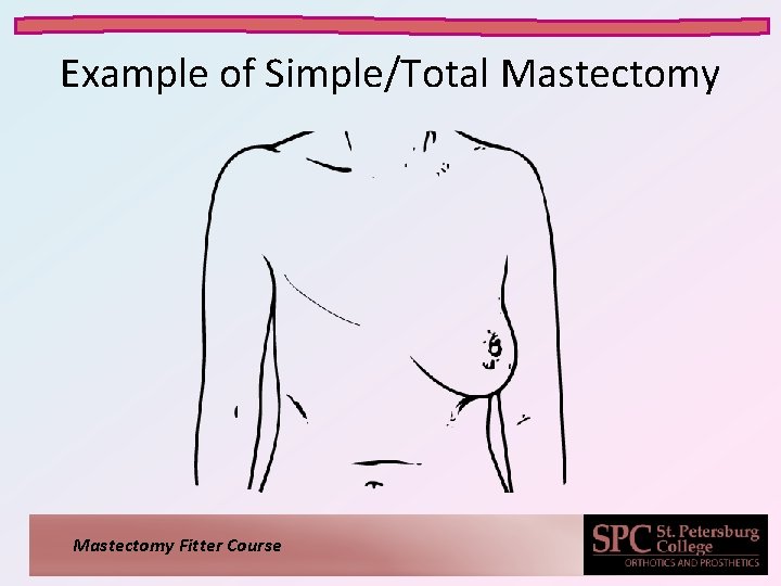Example of Simple/Total Mastectomy Fitter Course 