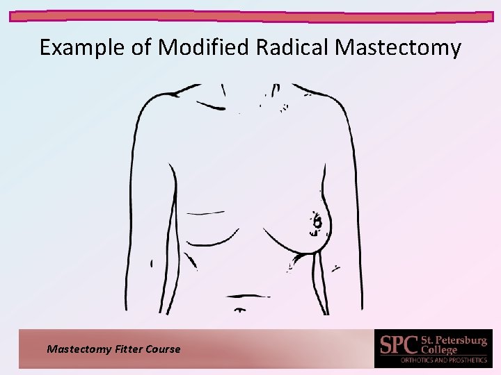 Example of Modified Radical Mastectomy Fitter Course 