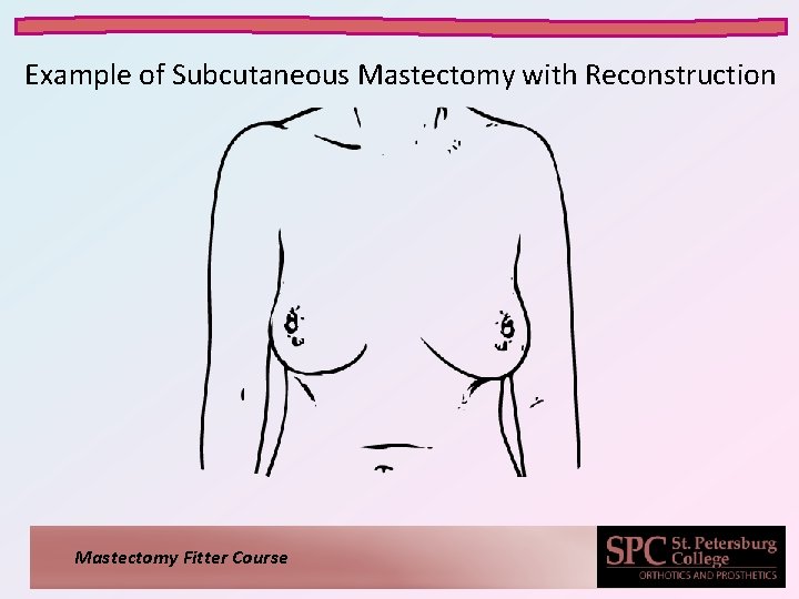 Example of Subcutaneous Mastectomy with Reconstruction Mastectomy Fitter Course 