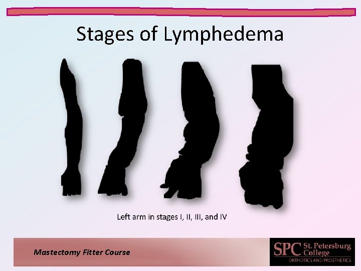 Stages of Lymphedema Mastectomy Fitter Course 
