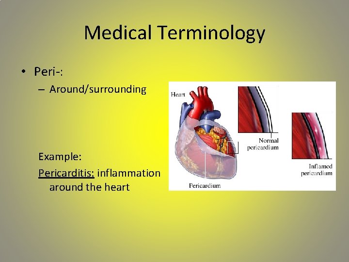 Medical Terminology • Peri-: – Around/surrounding Example: Pericarditis: inflammation around the heart 