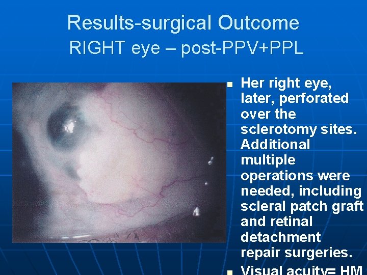 Results-surgical Outcome RIGHT eye – post-PPV+PPL n Her right eye, later, perforated over the